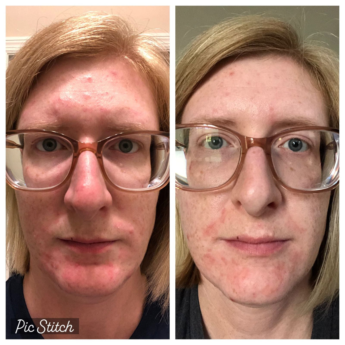 AN SKIN - Clarifying Acne Serum