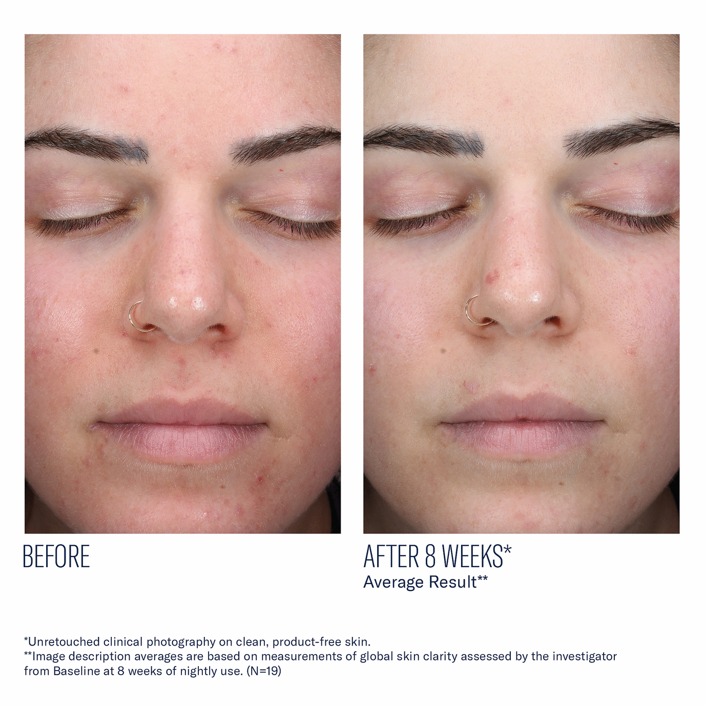 Skinbetter - AlphaRet Clearing Serum - 1.0 fl. oz.