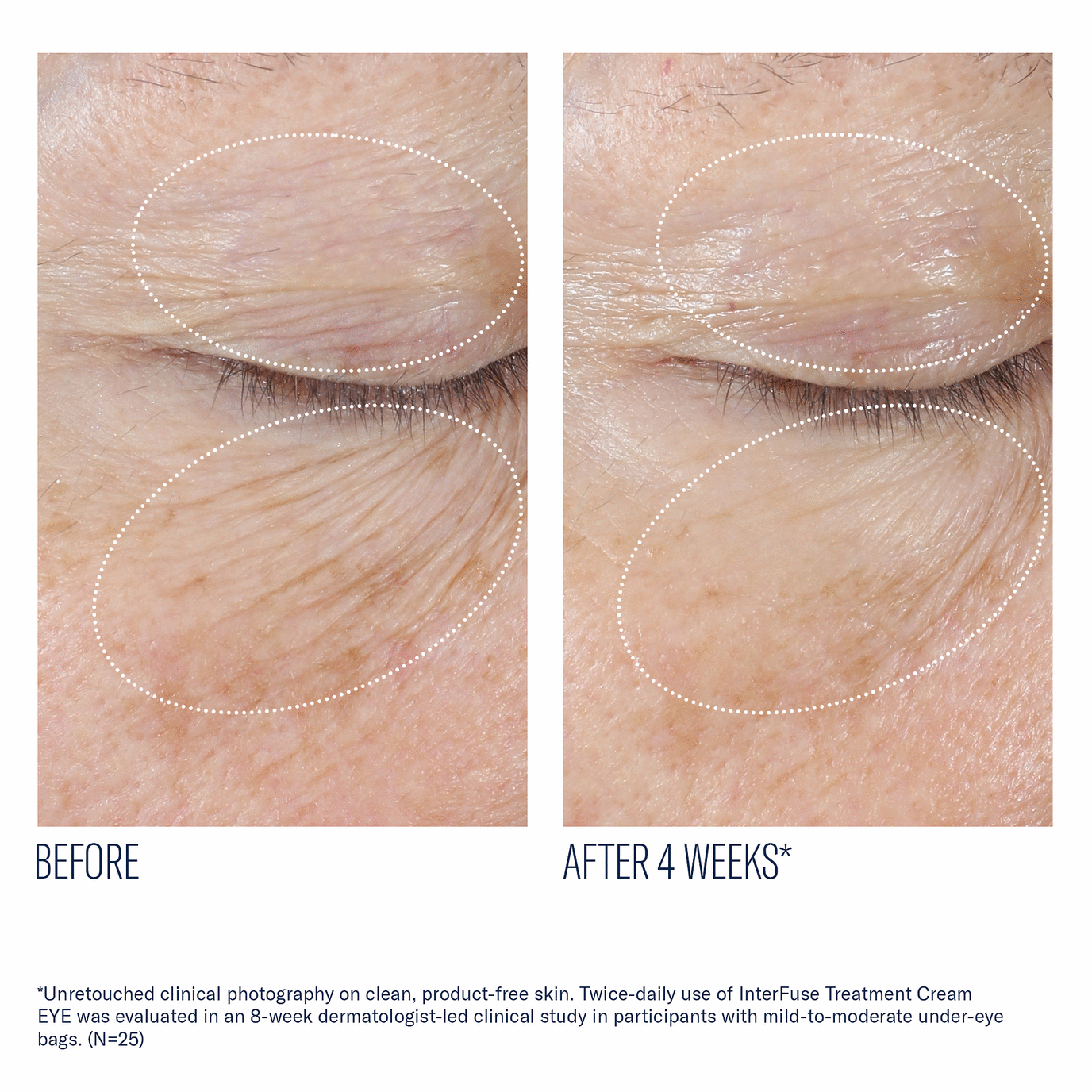 Skinbetter - Interfuse Treatment Cream Eye - 0.5 fl. oz.